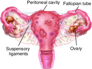 Endometriosis KNOW MORE