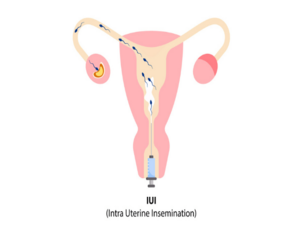 Intra Uterine Insemination(IUI) KNOW MORE